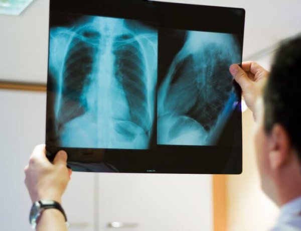 Tüdőrákszűrési program  Nyíregyházán                                                       