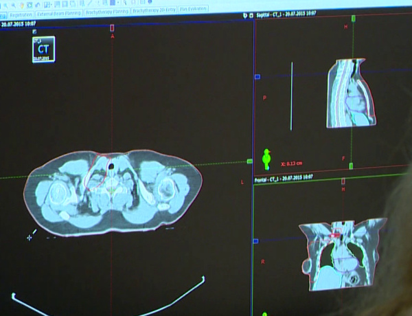 Így is lehet életet menteni - Szűrővizsgálattal megelőzhető a daganat  