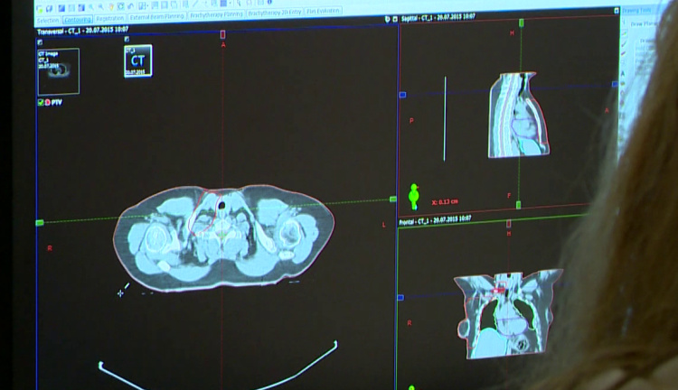 Így is lehet életet menteni - Szűrővizsgálattal megelőzhető a daganat  